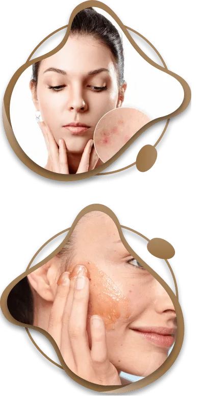 Best Face Acne Treatment Dubai