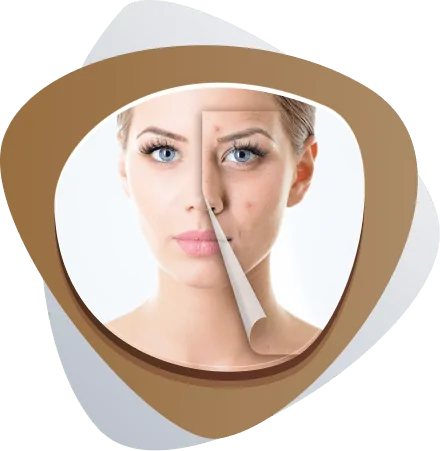 Acne Treatment Dubai