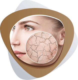 Acne Treatment in Dubai