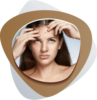 Best Acne Treatment in Dubai