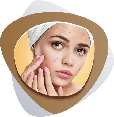 Best Acne Treatment Dubai
