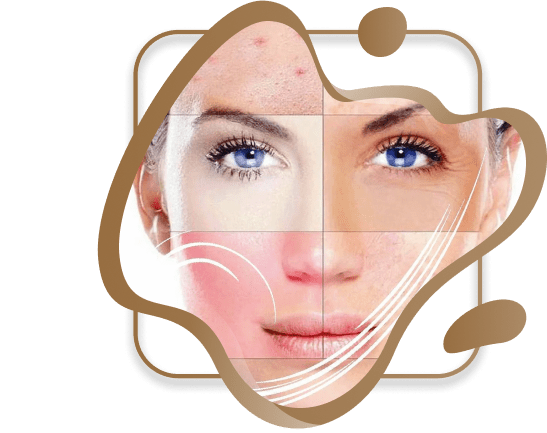 Best Acne Treatment in Dubai UAE