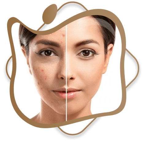 Best Acne Treatment