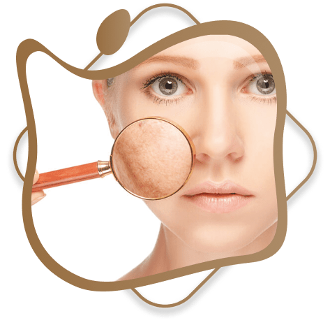 Acne Treatment
