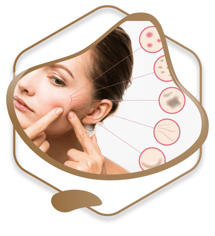 Face Acne Treatment Dubai
