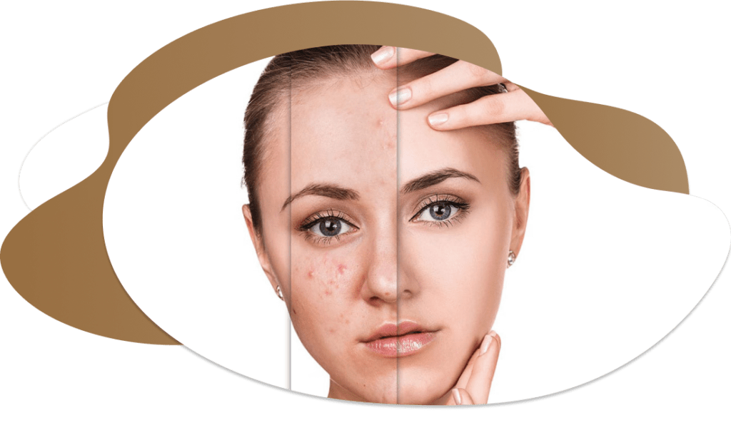 Best Face Acne Treatment in Dubai