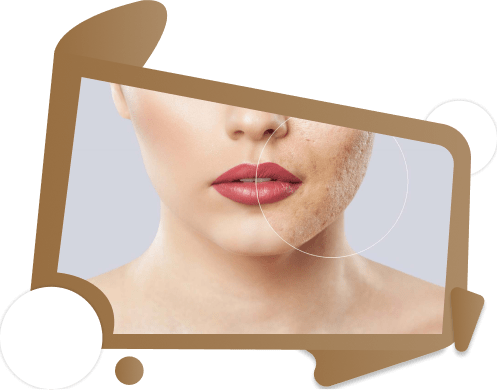 Acne Treatment in Dubai UAE