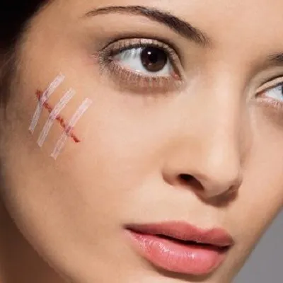 can glutathione remove old scars What Should You Know About Scar Revision For Acne Scarring? Your 30s & 40s Tier:Online Vitamin H