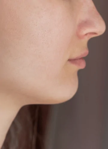 Best Acne Treatment in Dubai UAE
