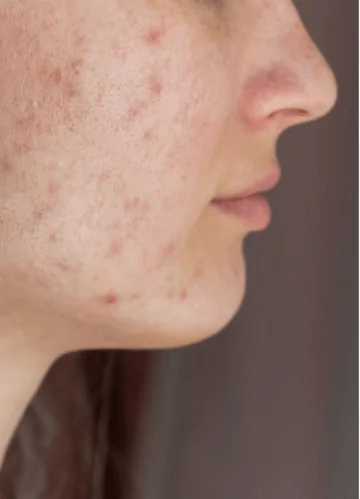 Best Acne Treatment in Dubai UAE