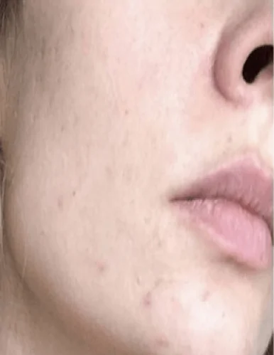 Best Acne Treatment