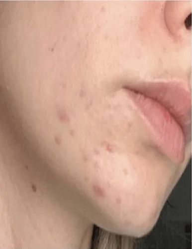 Best Acne Treatment