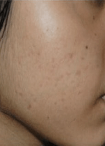 Best Acne Treatment in Dubai