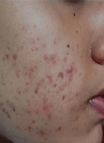 Best Acne Treatment in Dubai