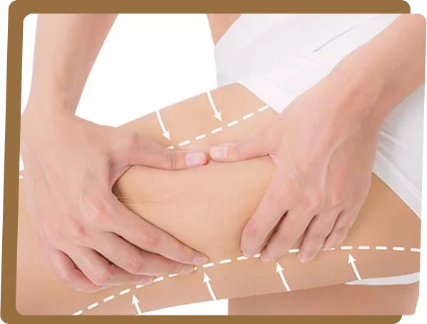 Thigh Lift treatment