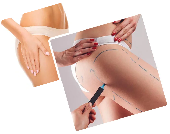 Thigh Lift treatment in Dubai