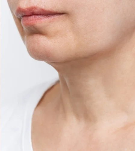 Skin tightening in Dubai