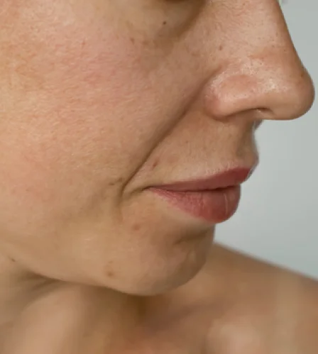 Skin tightening treatment in Dubai Skin tightening treatment in Dubai