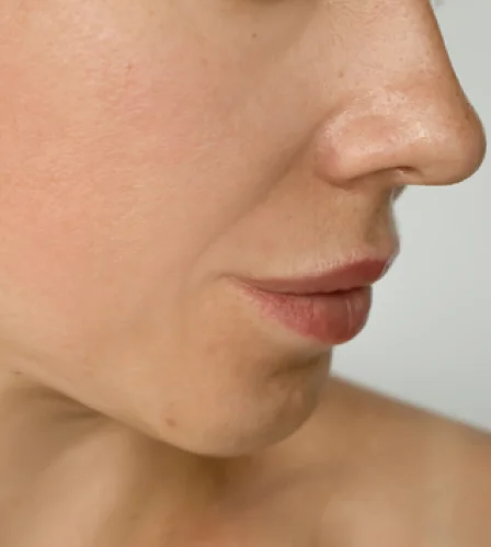 Skin tightening treatment in Dubai