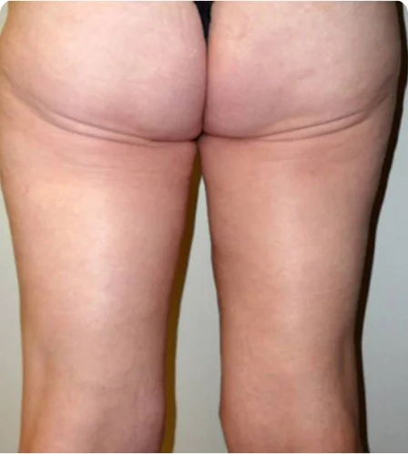 Thigh Lift in Dubai