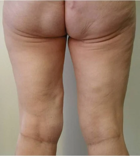 Thigh Lift in Dubai