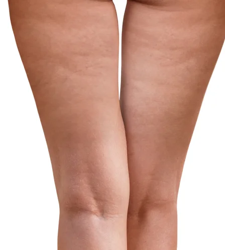 Thigh Lift