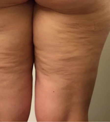 Thigh Lift Dubai