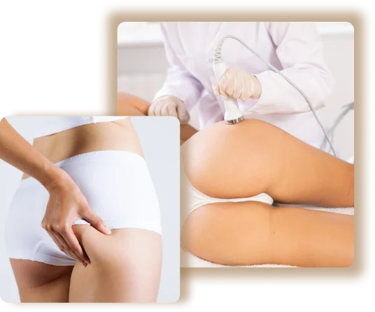 Buttock Augmentation treatment in Dubai