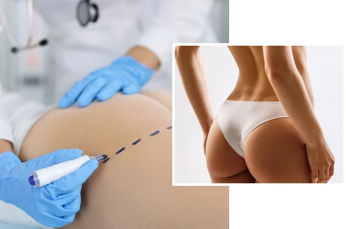 Buttock augmentation in Dubai