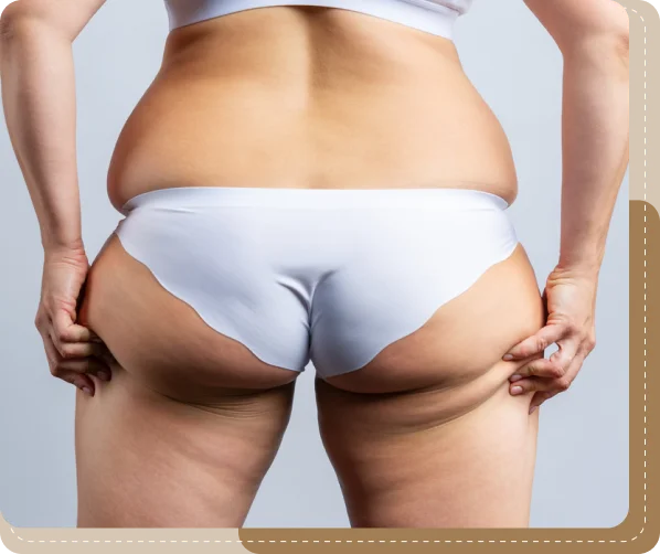 Buttock augmentation