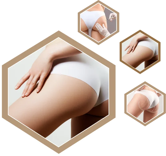 Buttock Augmentation treatment Dubai