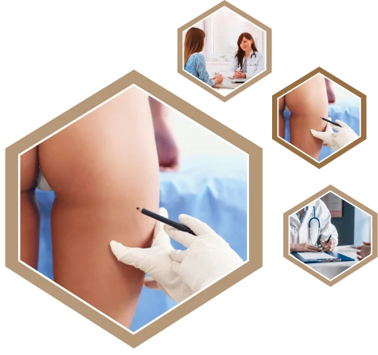 Buttock Augmentation