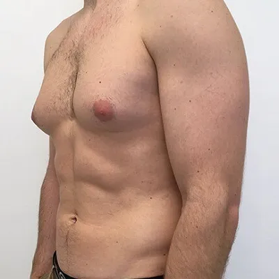 What Are The Risks Of Not Treating Gynecomastia?