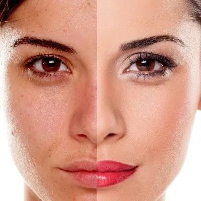 glutathione patches help melasma How Effective Is TCA Peel For Melasma? Helicobacter pylori and gastric