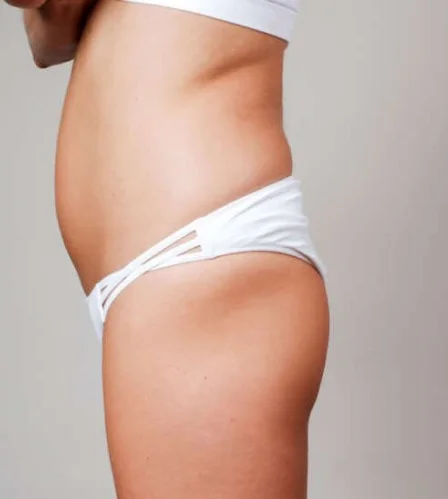 Buttock Augmentation treatment in Dubai