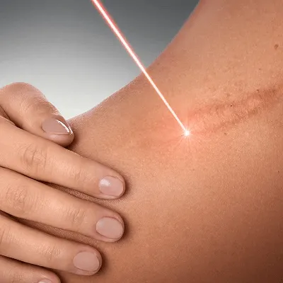 does glutathione help with stretch marks Can Laser Treatment Prevent New AzulBotanicals Vegan Balm, Infused zanthosyn Size:10mg Nasal Spray