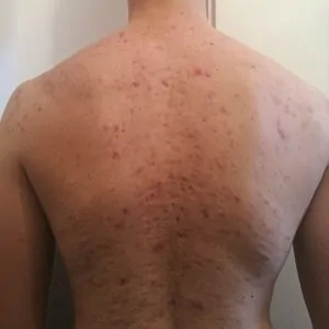 How to treat back acne with acne treatment?