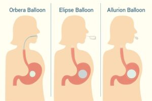 Comparison chart showing Orbera, Elipse, and Allurion gastric balloons with insertion methods and stomach placement