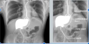 X-ray images of gallbladder and bile ducts labeling gallbladder, common bile duct, cystic duct, and liver, used for diagnosing gallstones and biliary tract issues.