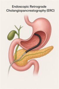 Illustrated Endoscopic Retrograde Cholangiopancreatography (ERCP) procedure showing endoscope insertion through stomach to bile ducts and pancreas for diagnosing and treating gallbladder stones and blockages