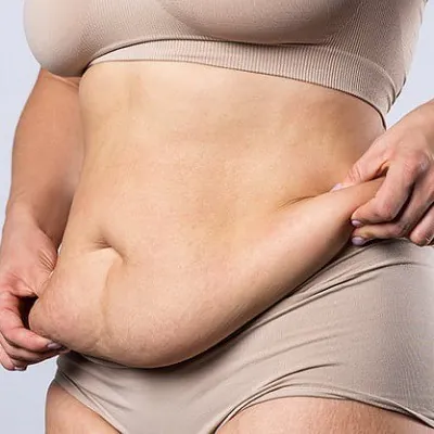 Post Weight Loss Treatments in Dubai