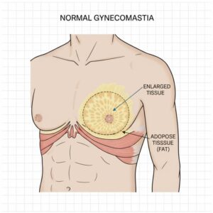 Diagram illustrating normal gynecomastia with labeled enlarged tissue and adipose tissue (fat) in the male chest area, featuring a detailed anatomical view for medical education.