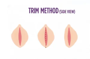 Cosmetic gynecology trim labiaplasty Dubai