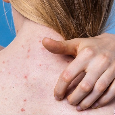What Causes Back Acne In Females
