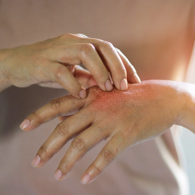 Eczema Treatment in Dubai