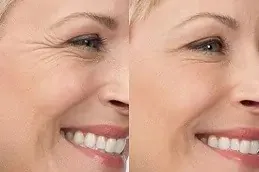 botox dubai price