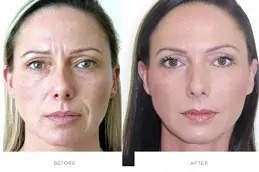 botox in dubai price