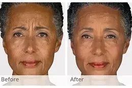 botox injection price