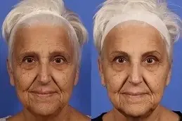 botox price dubai