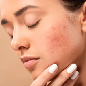 Closed Comedones on Face